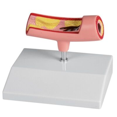 Arterienmodell einteilig Längsschnitt einer Arterie mit Verengungen