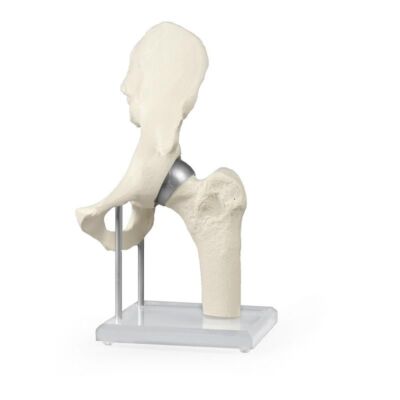Hüftgelenk mit Schalenprothese