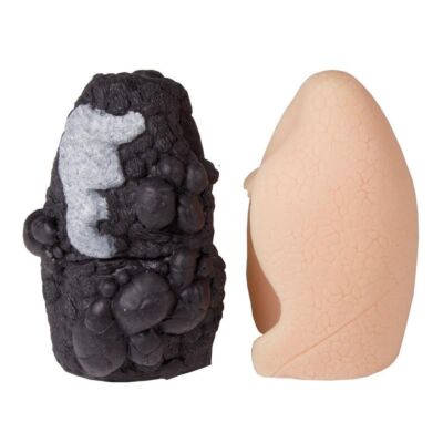 Lungenkrebs-Vergleichsmodell