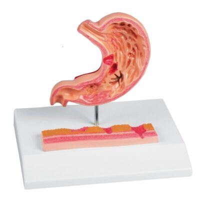 Magen mit Magengeschwüren