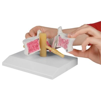 Osteoporose-Wirbel 2-fach vergrößert