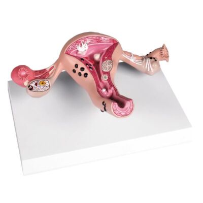 Uterusmodell mit Erkrankungen