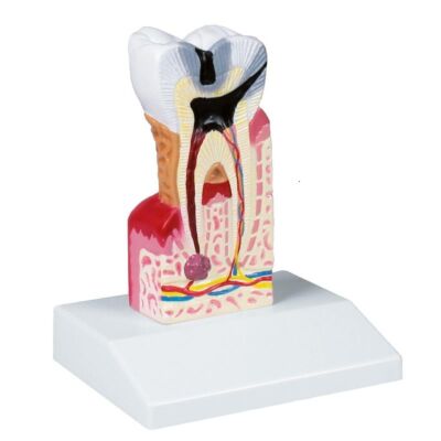 Zahnkariesmodell 10-fache Größe