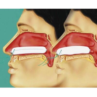 Raucocel Nasentamponade